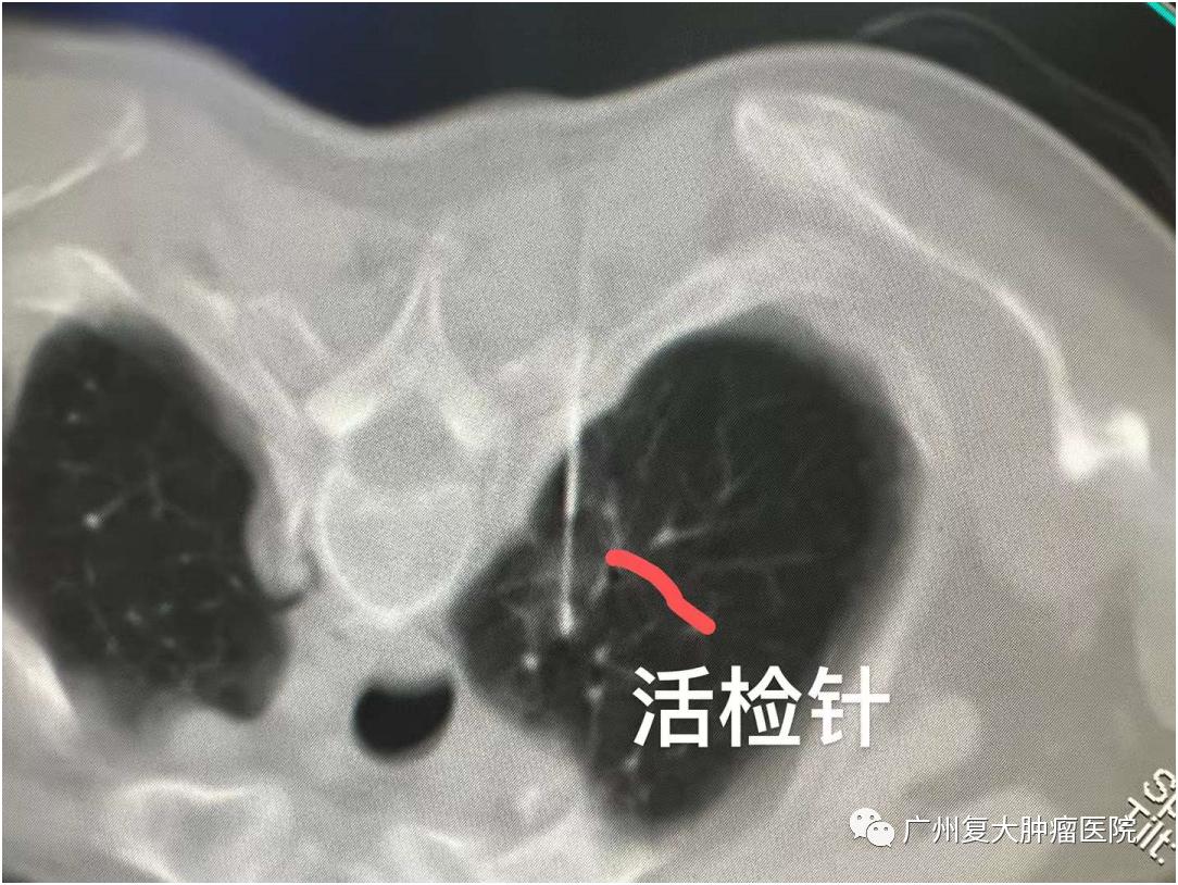 最新肺结节贴吧热议话题与探讨